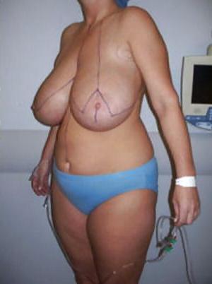 25P Big Natural And Saggy Tits Pre-OP Pictures