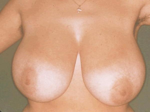25P Big Natural And Saggy Tits Pre-OP Pictures