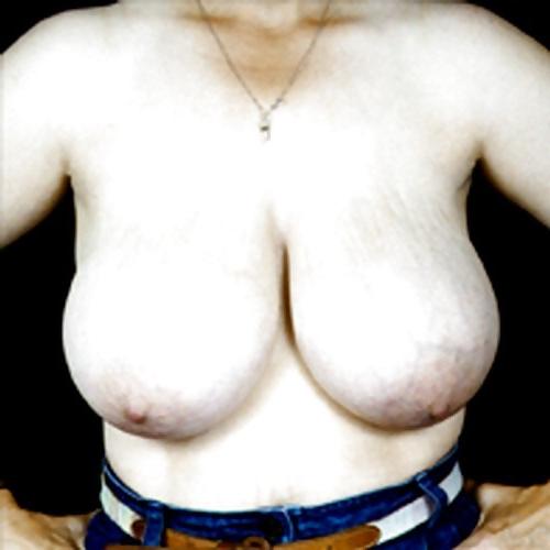 25P Big Natural And Saggy Tits Pre-OP Pictures