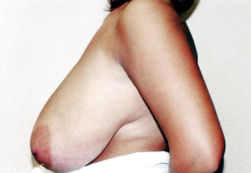 25P Big Natural And Saggy Tits Pre-OP Pictures