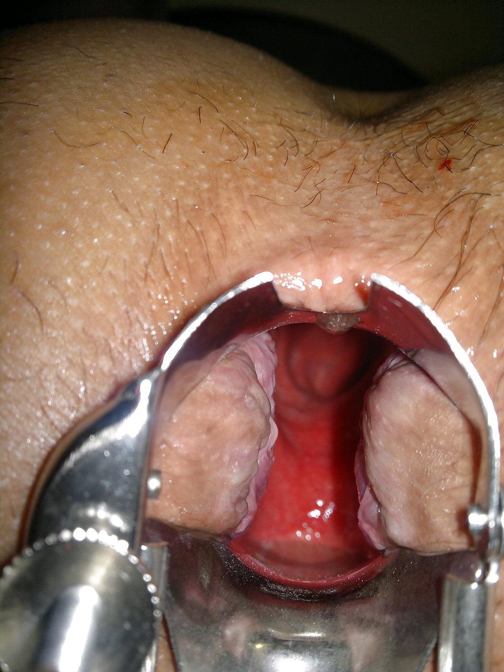 8P Anal Speculum