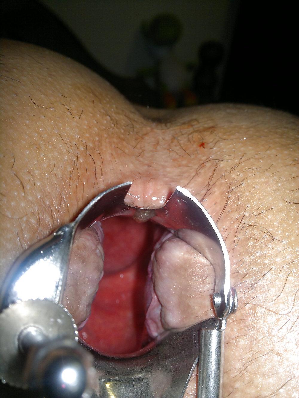 8P Anal Speculum