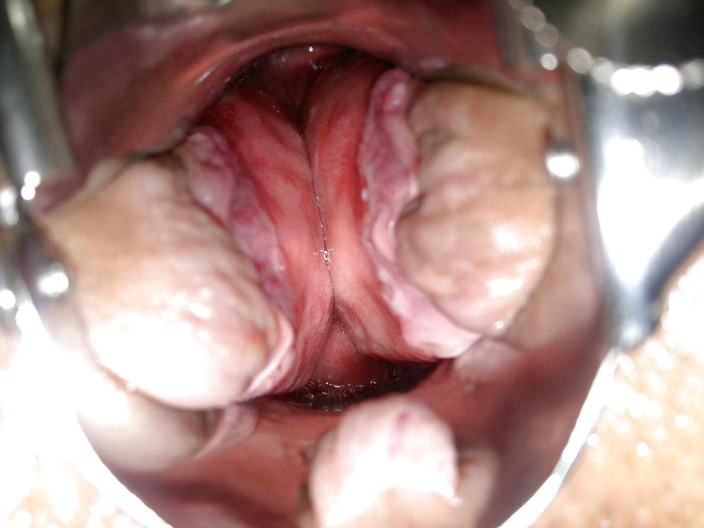 8P Anal Speculum