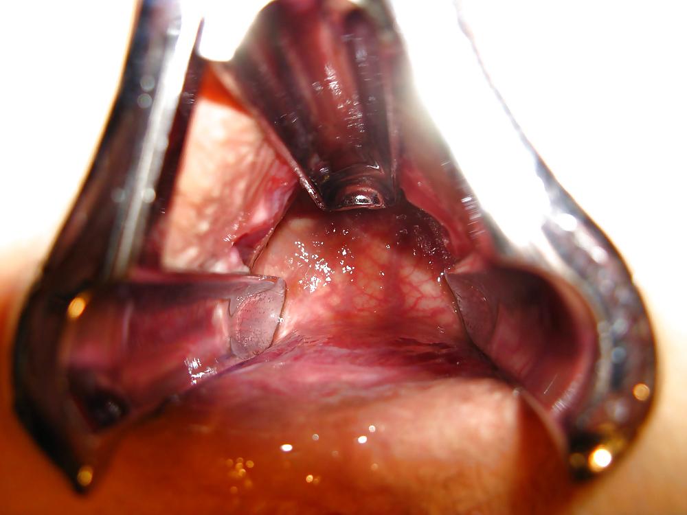 25P Speculum