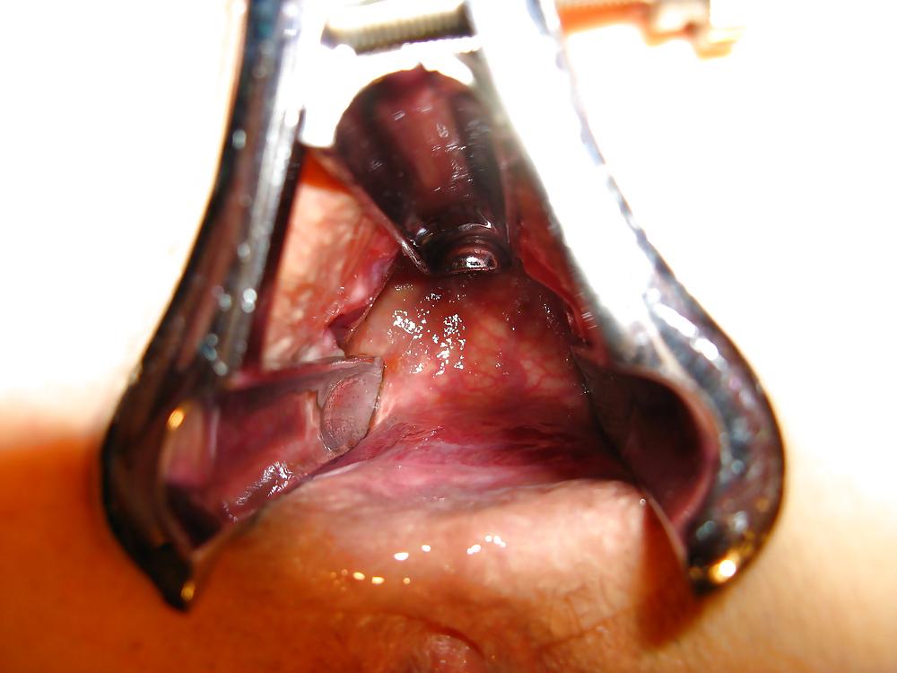 25P Speculum