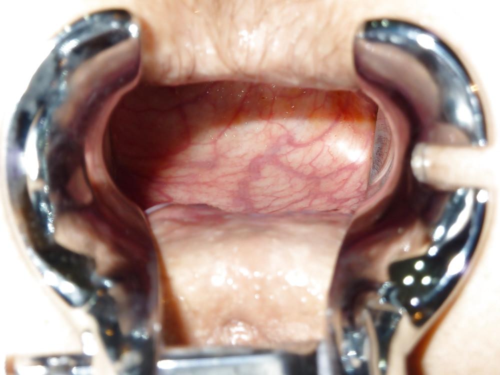 25P Speculum