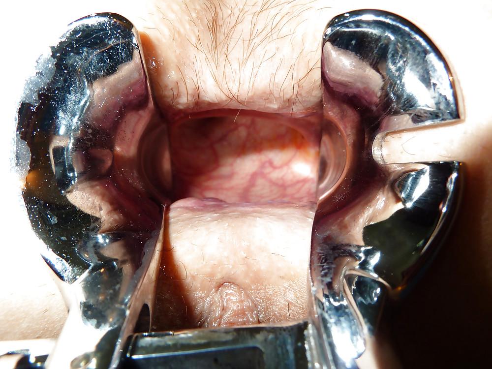 25P Speculum