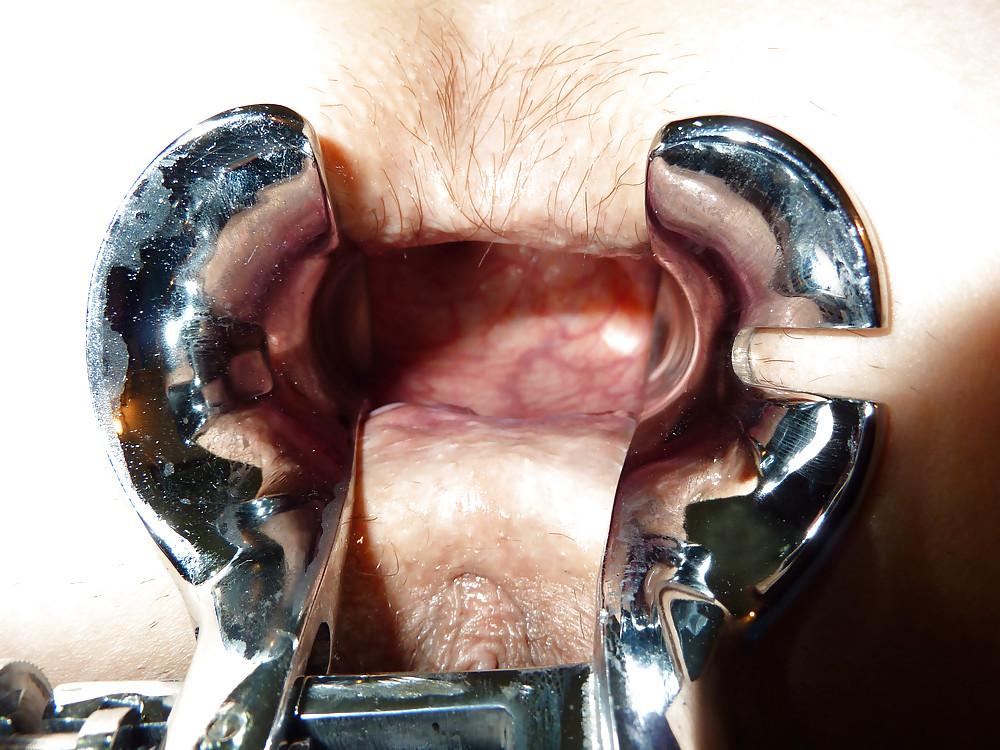 25P Speculum