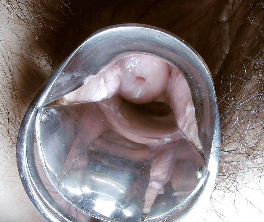 14P Speculum