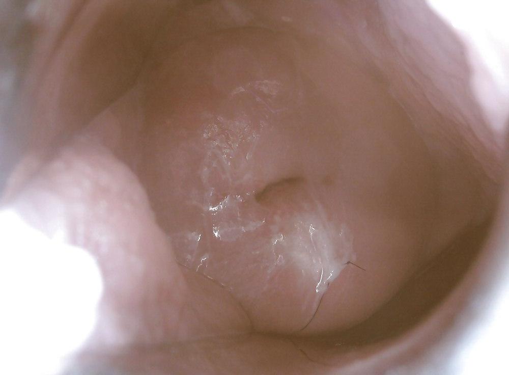 14P Speculum