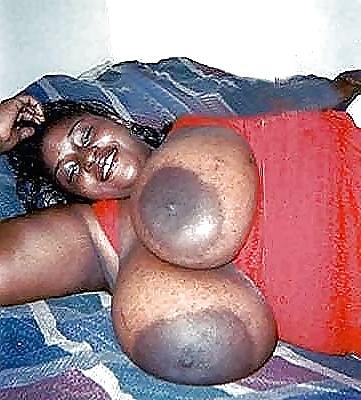 12P Huge areolas