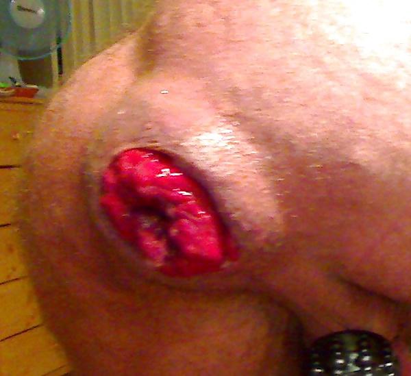 6P Nice prolapse hole