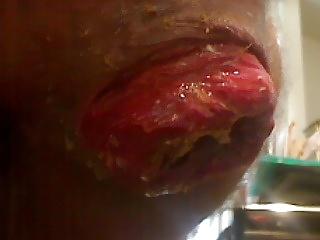 6P Nice prolapse hole