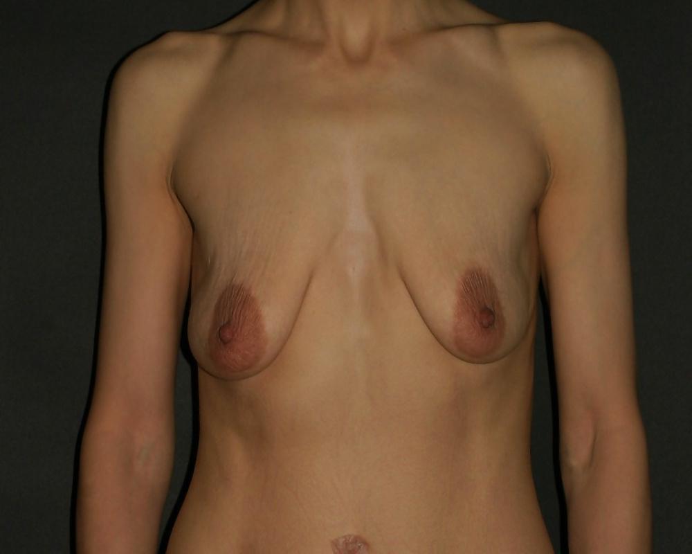25P Stretchmarked Tits & Nipples