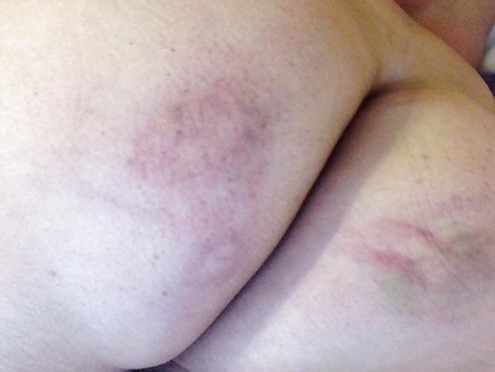 5P Amateur Spanked Ass