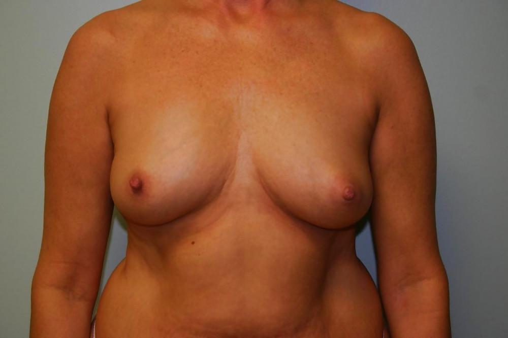 20P Beautiful boobs before surgery