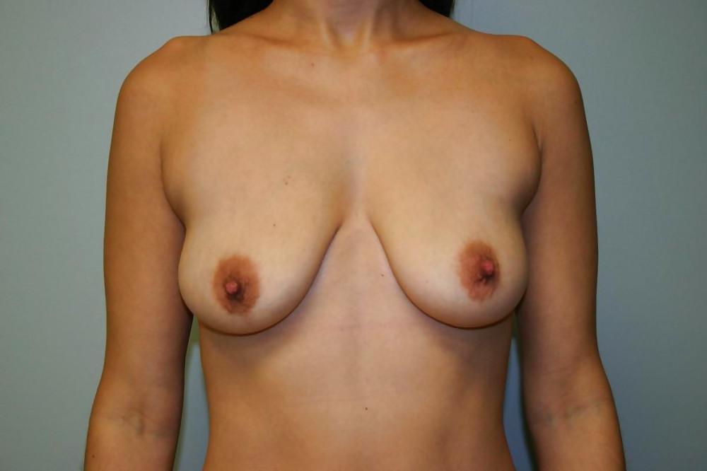 20P Beautiful boobs before surgery