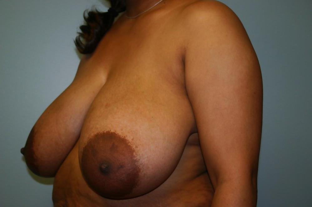20P Beautiful boobs before surgery