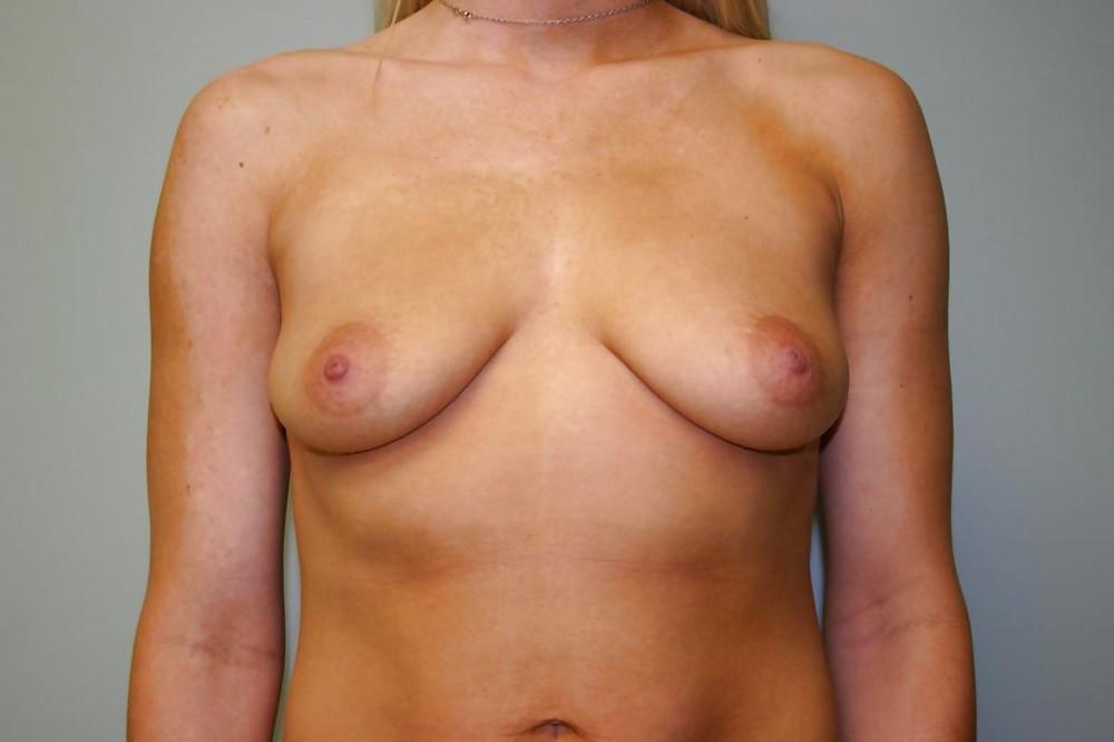 20P Beautiful boobs before surgery