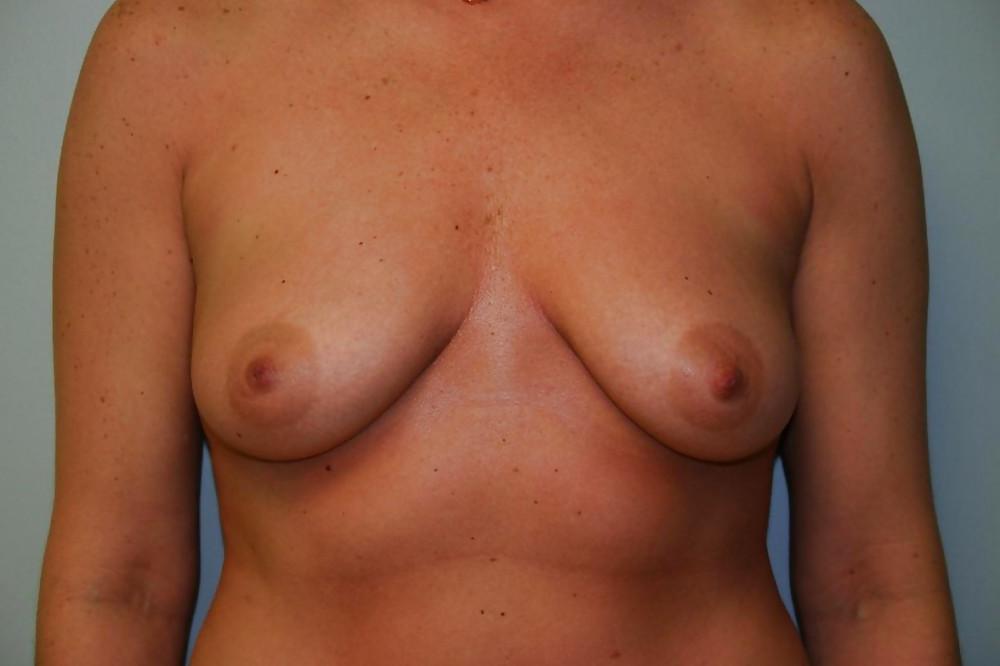 20P Beautiful boobs before surgery