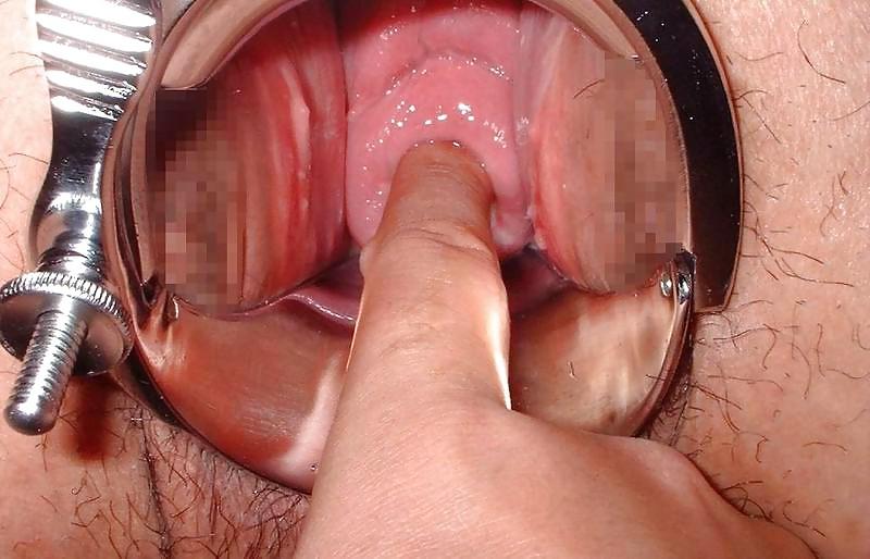 25P Speculum
