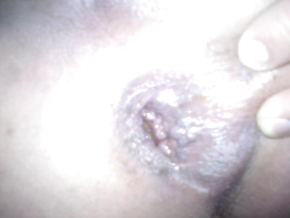 6P Open hole