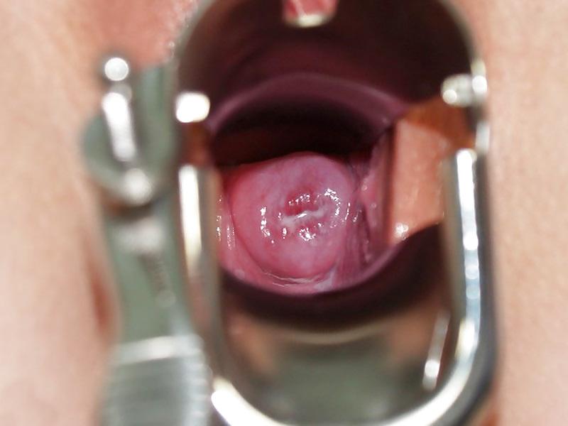 25P Speculum
