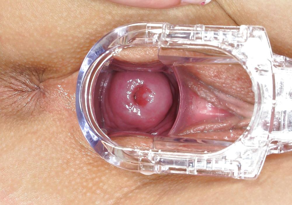 25P Speculum