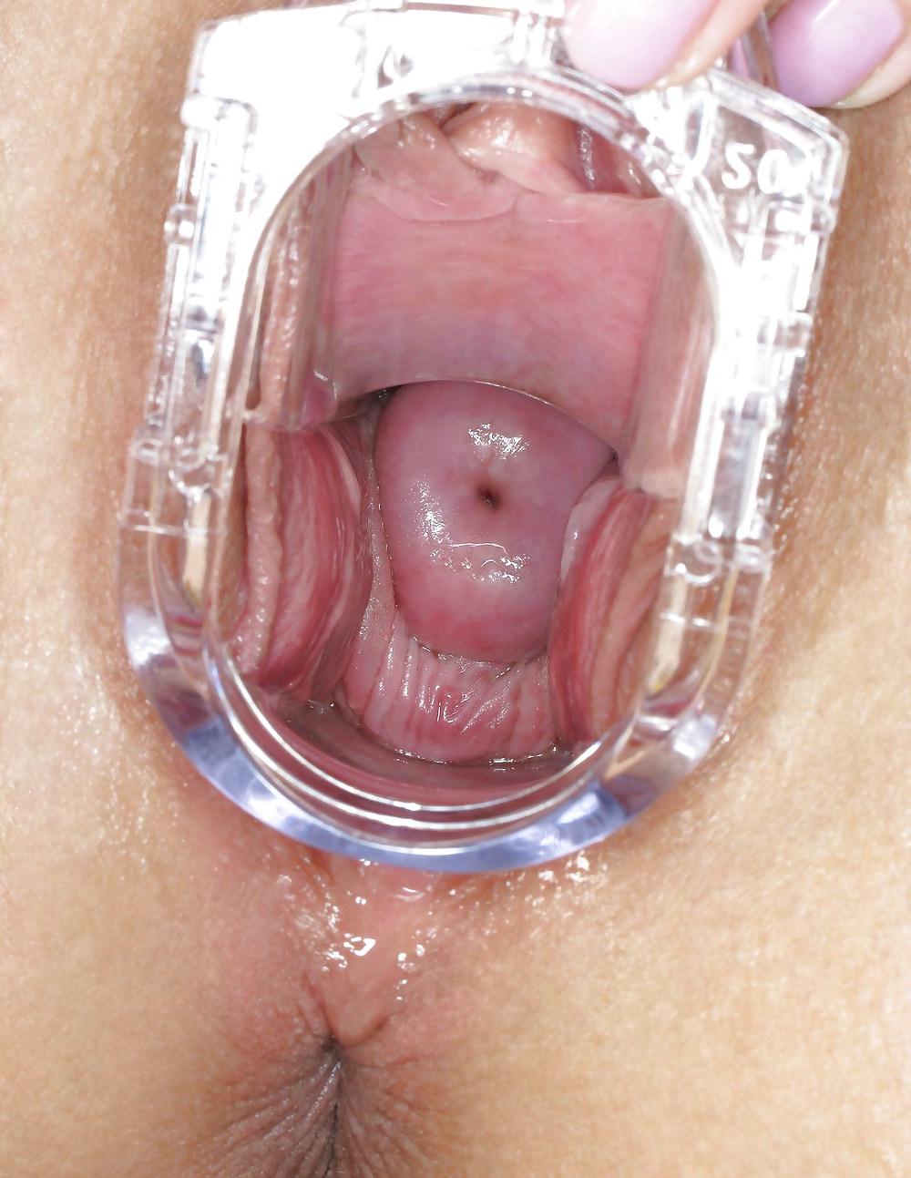 20P Speculum views