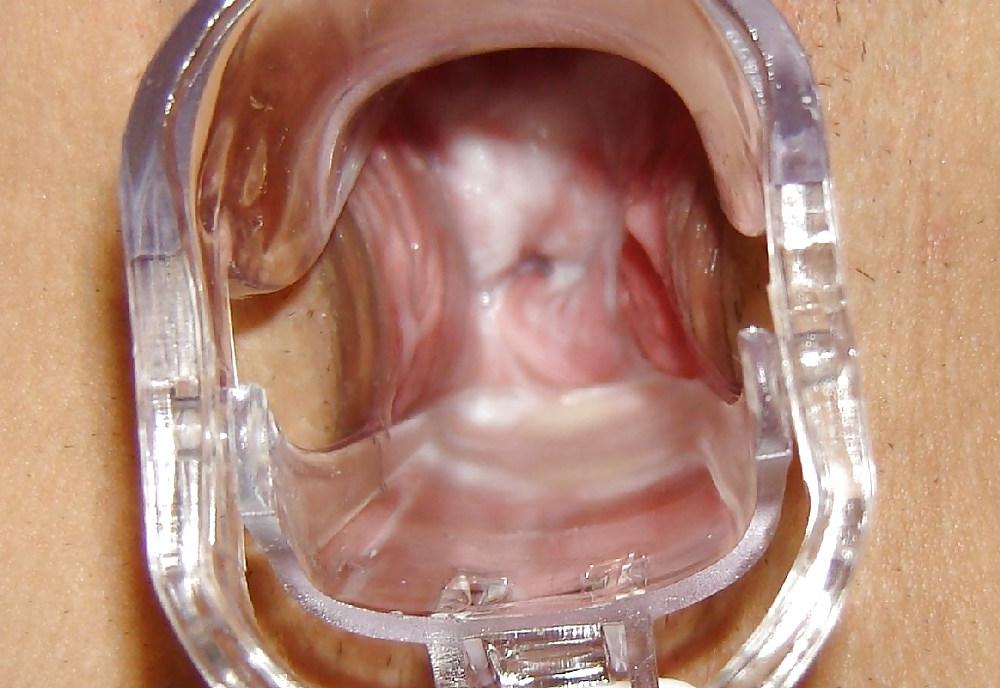 20P Speculum views