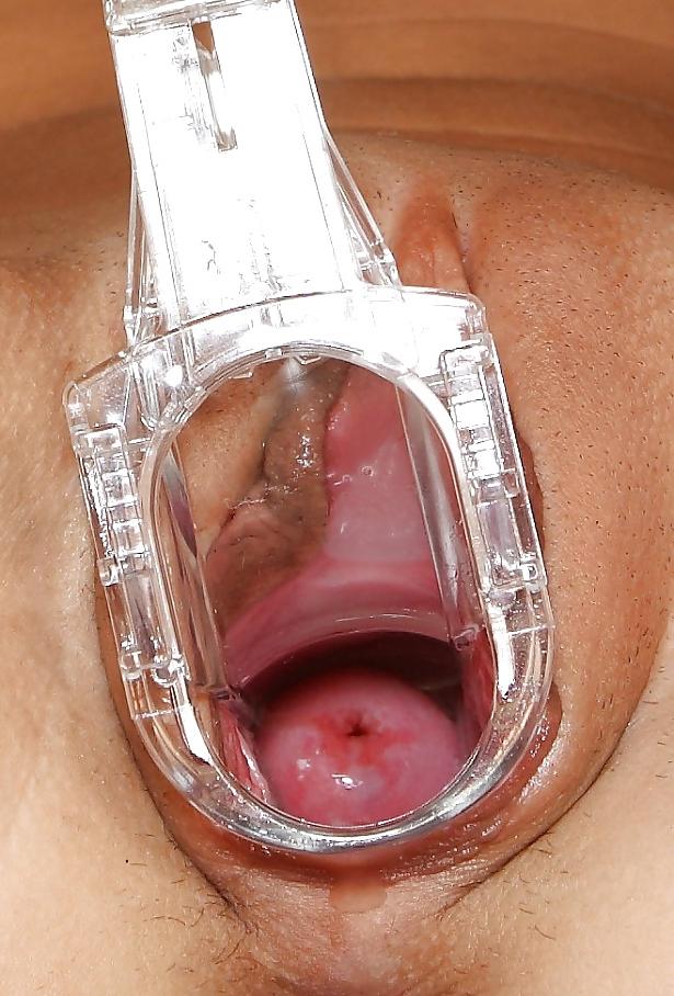 20P Speculum views