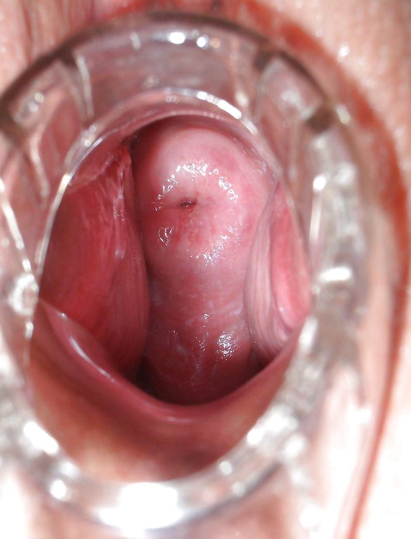 20P Speculum views