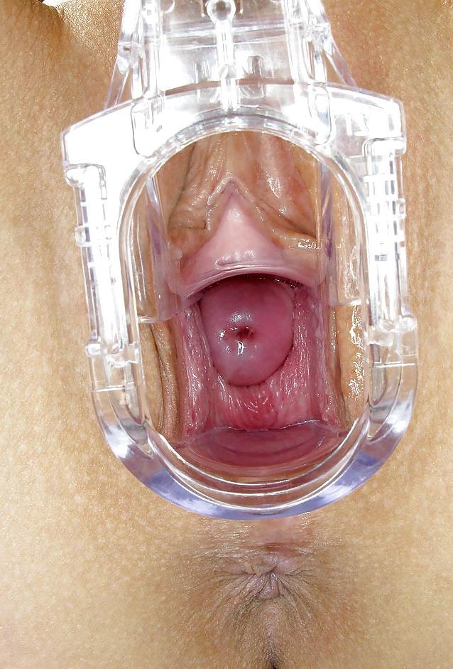 20P Speculum views