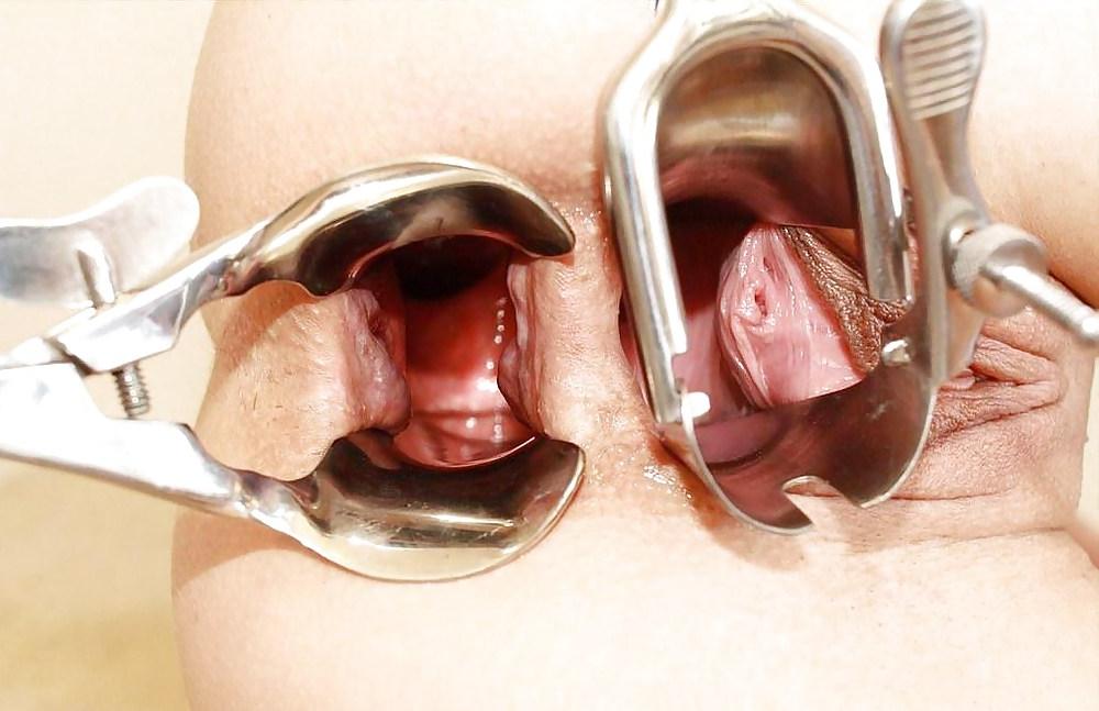 20P Speculum views