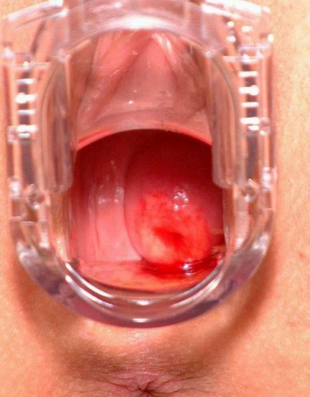 15P hot babes stretch their twats by speculum