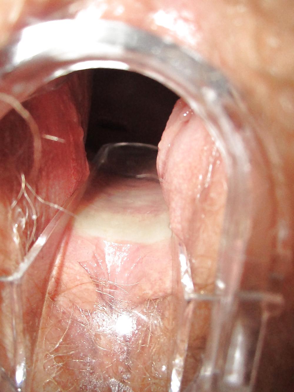 25P Speculum