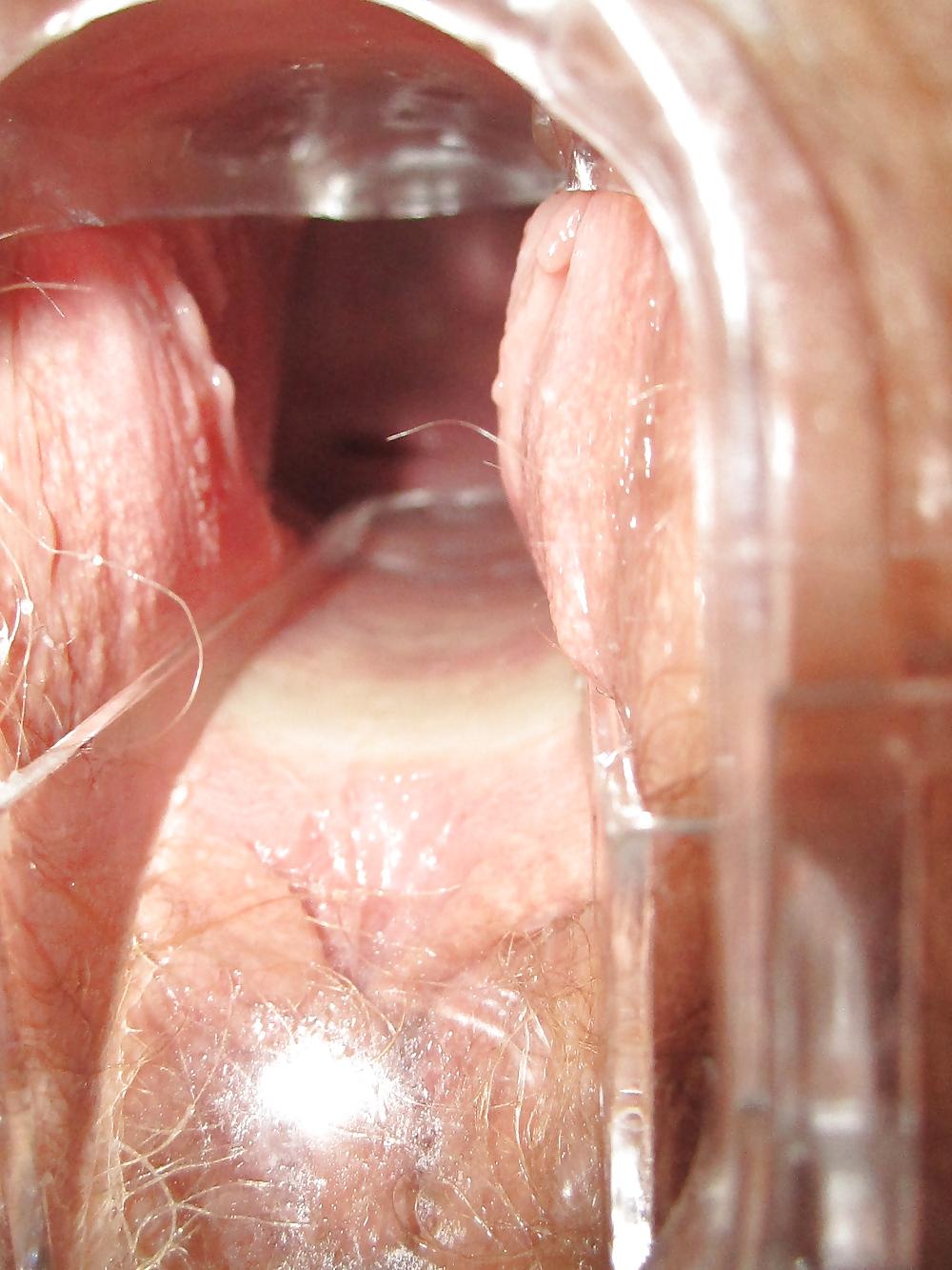 25P Speculum
