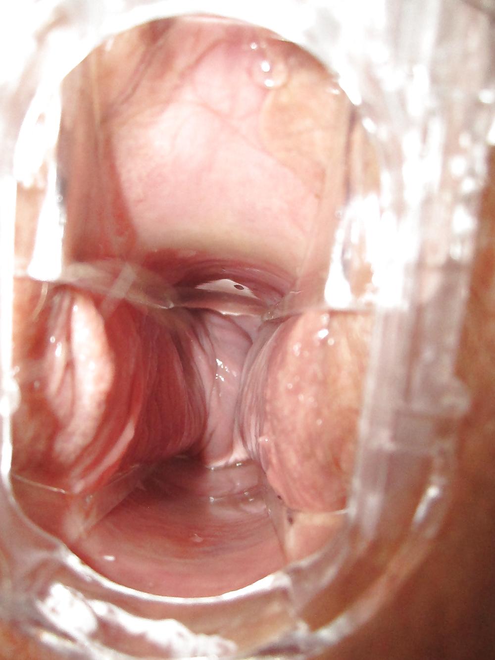 25P Speculum
