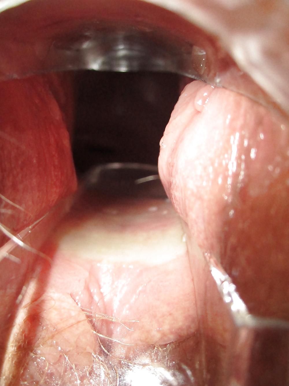 25P Speculum