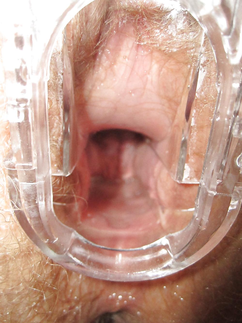 25P Speculum