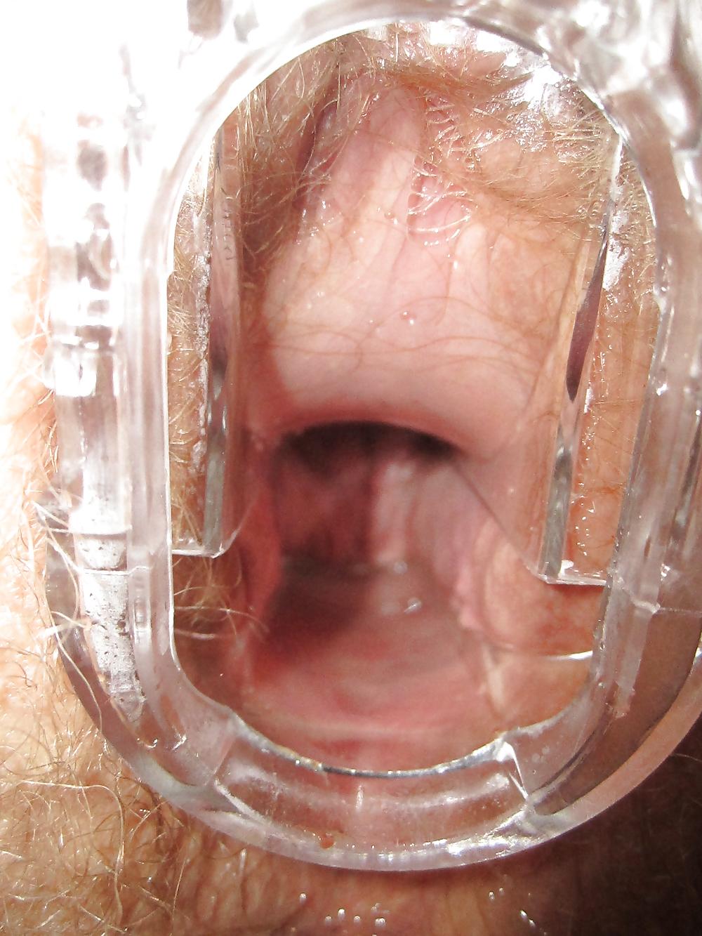 25P Speculum