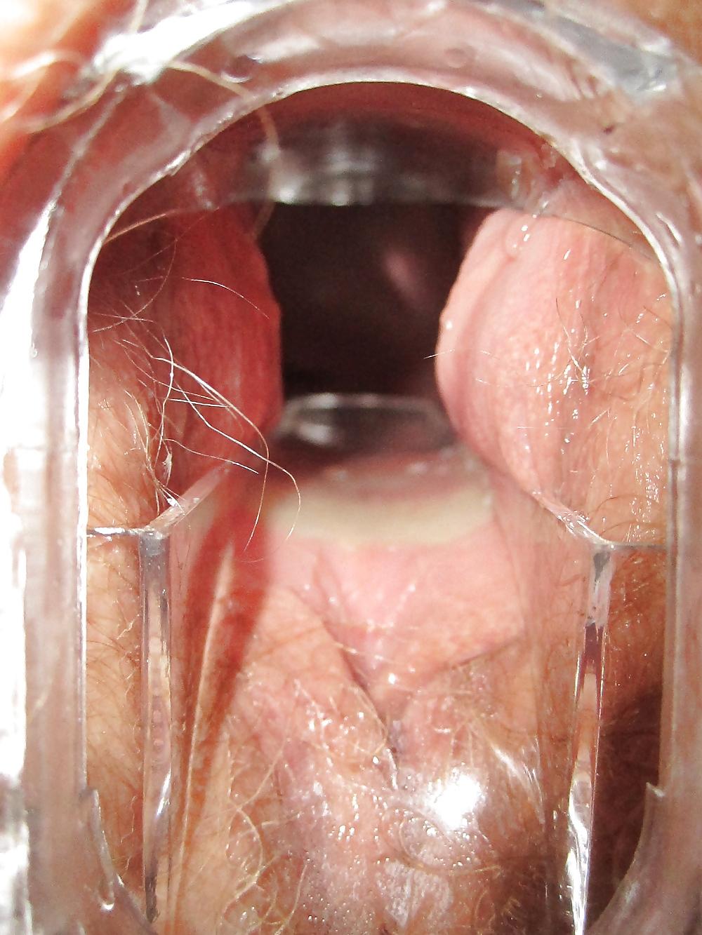 25P Speculum