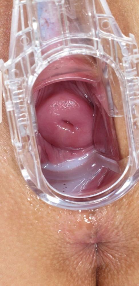 25P SPECULUM OPEN WIDE BEAUTIES CERVIX VIEW #2 - CoViD-88