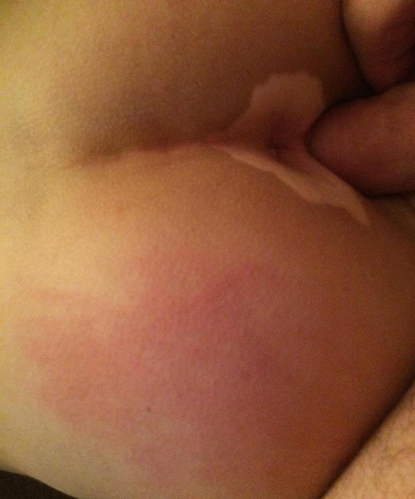 25P Vitiligo95 nude