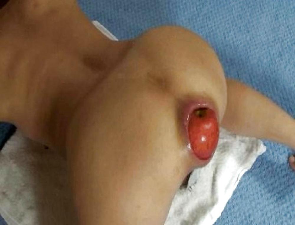 25P Extreme anal gapes