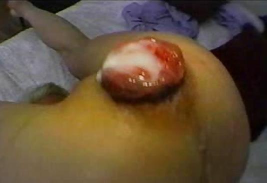 20P Cum and Prolapse
