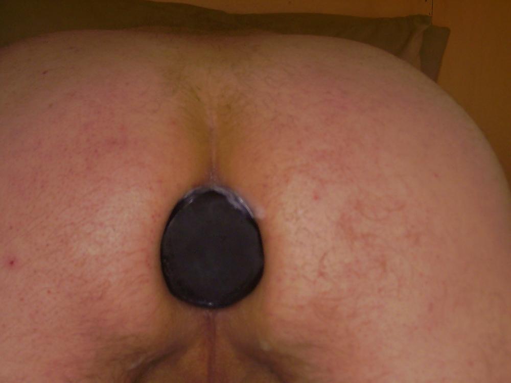 11P Anal speculum insertion
