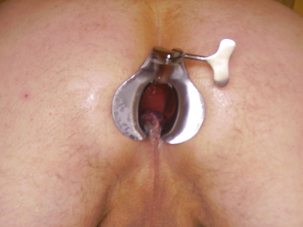11P Anal speculum insertion