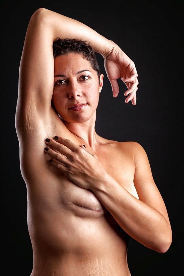 25P Amputee Mastectomy Handicapped