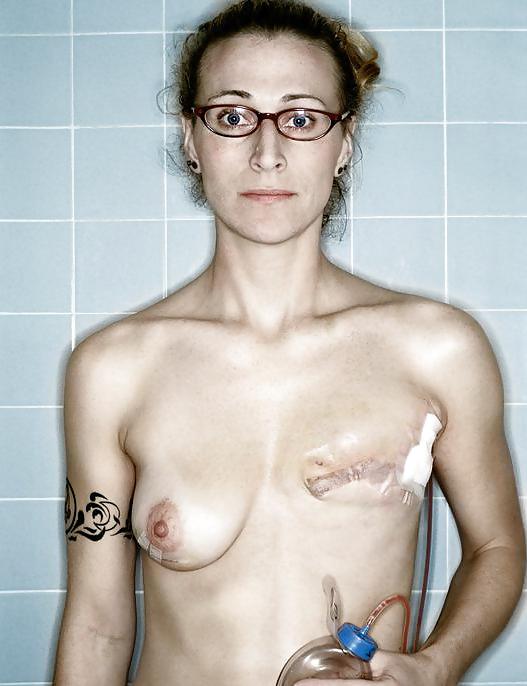 25P Amputee Mastectomy Handicapped